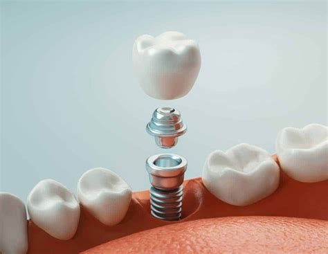 dental prosthesis calabasas, ca Dentist near me offered by Calabasas dental care located in Calabasas, CA 91302 for all your family and cosmetic dentistry needs